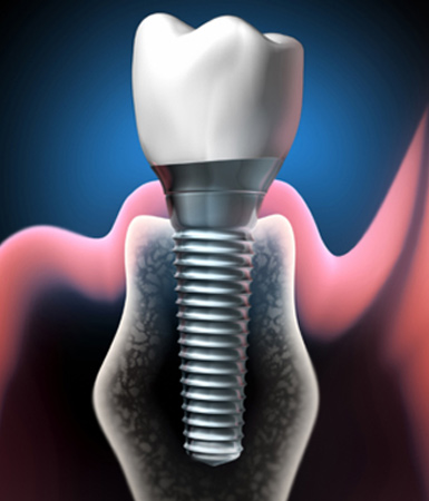 Implantes-ok